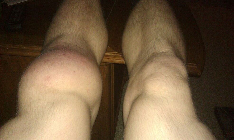 knie tot behandeling met OstyHealth
