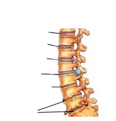 Stadia van ontwikkeling van osteochondrose