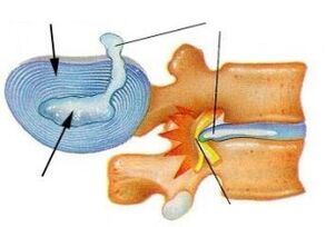 Vernietiging van de vezelachtige ring met cervicale osteochondrose