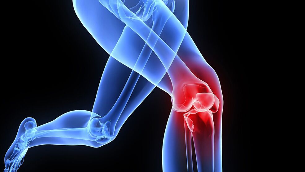 problemen met knieën als gevolg van artrose