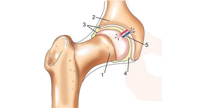 heupgewricht en artrose