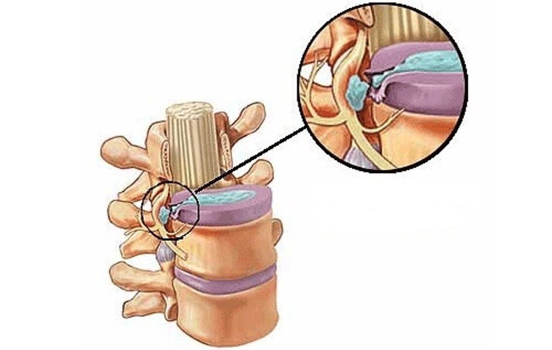 tussenwervelhernia met thoracale osteochondrose